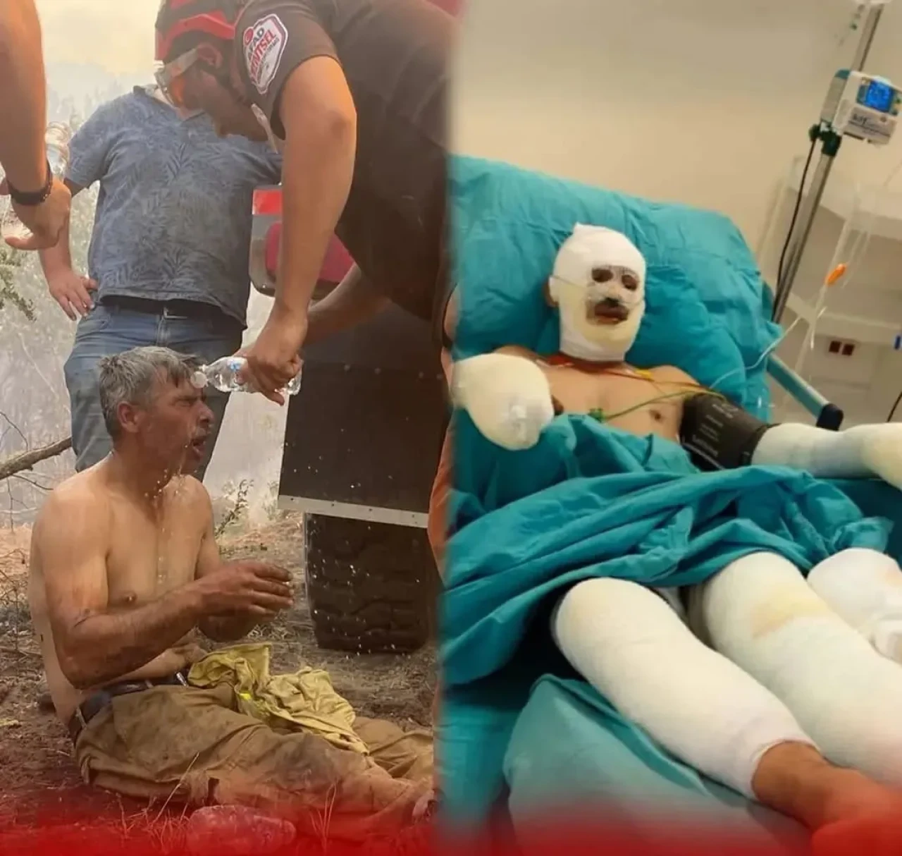Orman Yangınında Ağır Yaralandı