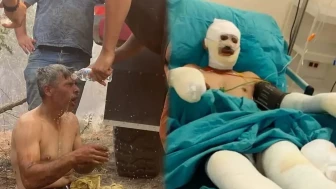 “Yanıyorum, Su Verin” Diye Feryat Eden Orman İşçisinin Son Hali Paylaşıldı