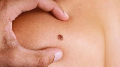 Skuamöz Hücreli Karsinom Nedir?